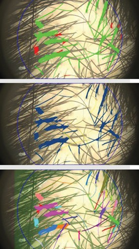 Figura 2. Imágenes representativas del tricograma del estudio. Las evaluaciones se realizaron con el sistema FotoFinder en condiciones estandarizadas para analizar el grosor del tallo piloso, la densidad folicular y la salud capilar general.